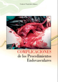 Image of Complicaciones de los procedimientos endovasculares